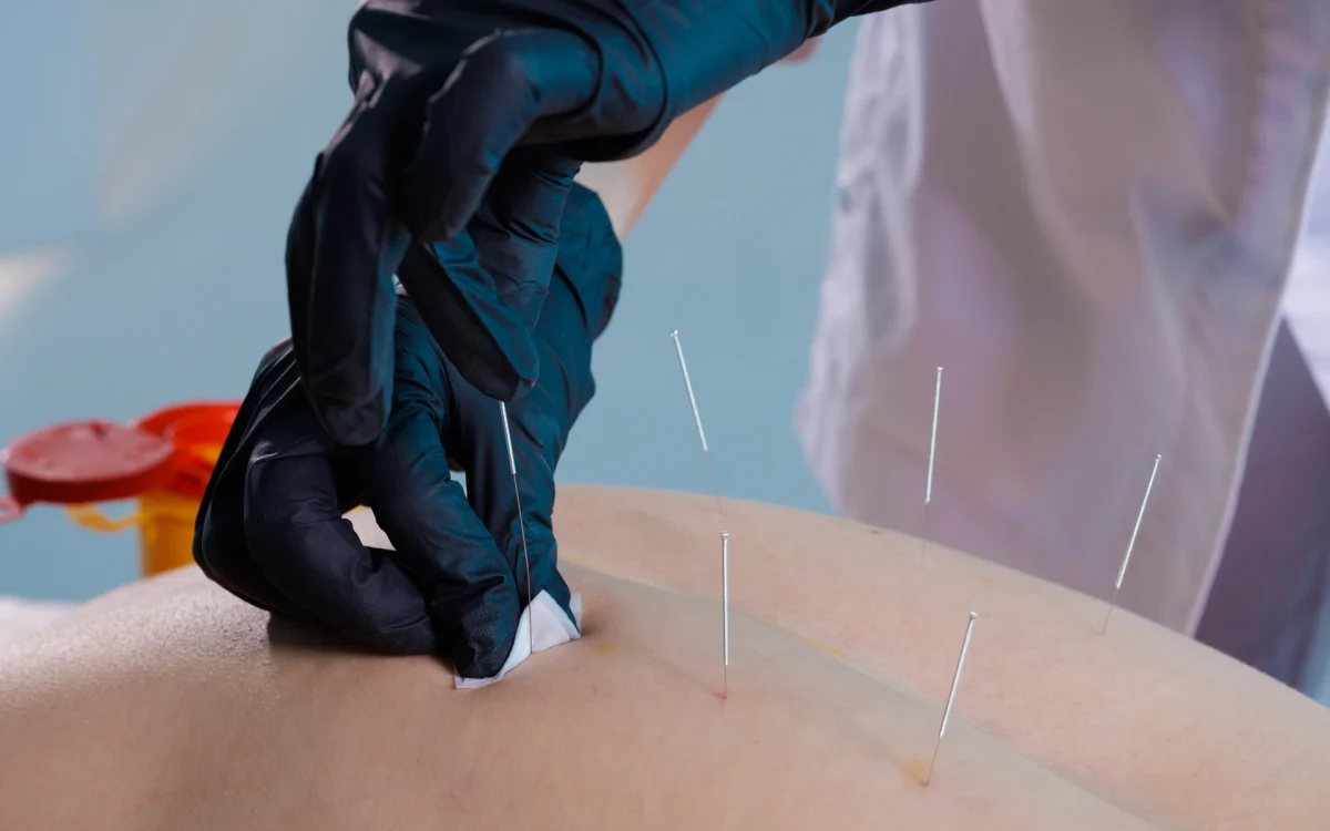 Dry Needling