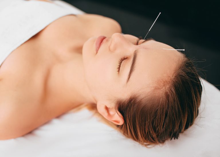 Patient receiving acupuncture with sterile needles to reduce pain and encourage recovery